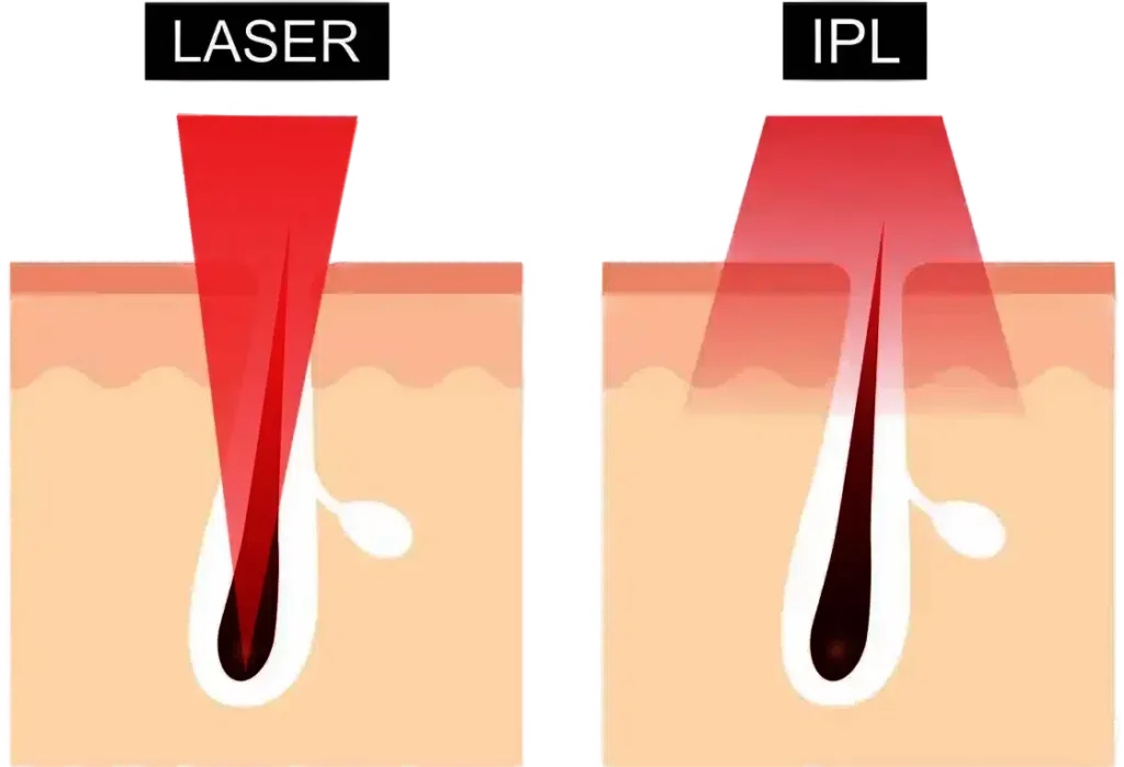 Verschil laser IPL Estaro