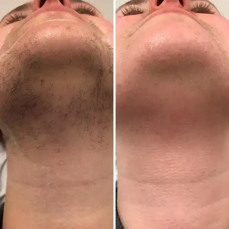 Laserontharing kin en hals resultaat voor en na